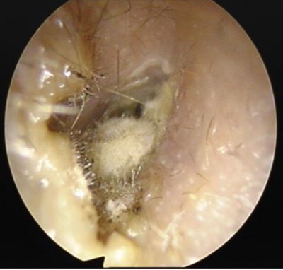 Ασθενής με φαγούρα στο αυτί - μύκητες στο αυτί